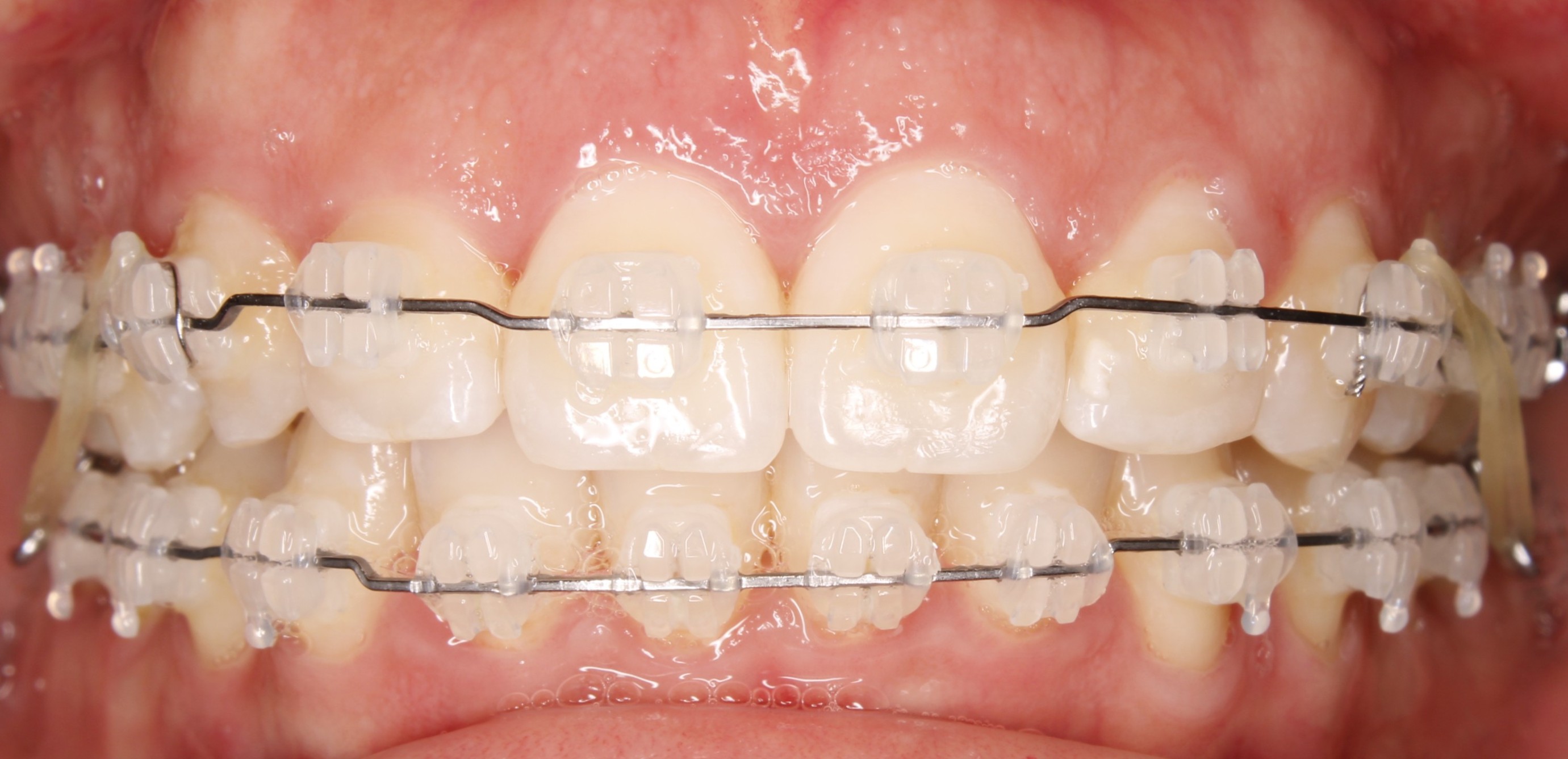 BRACKETS ESTÉTICOS